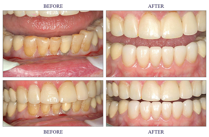 What is the dental procedure code for porcelain crowns and veneers?